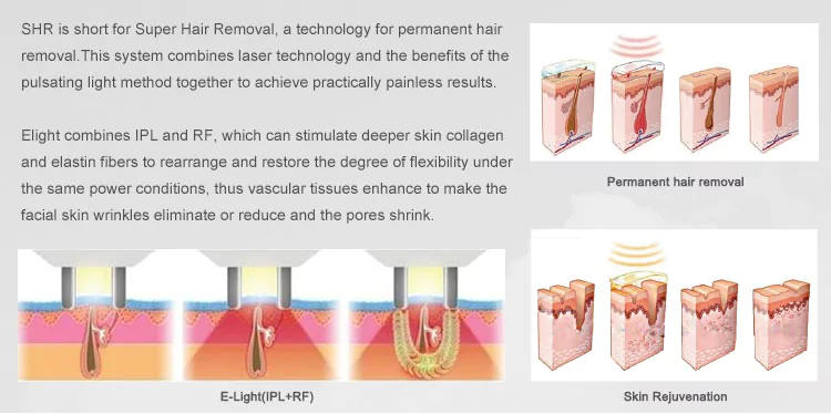 Benefits of the IPL Laser Machine 2 Elos SHR working theroy 1