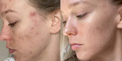 4 in 1 Laser Multifunctional Beauty Machine Diode ND Yag Elos RF 33 Acne treatment effect