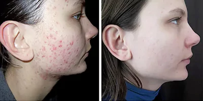 IPL SHR OPT Hair Removal Salon Machine 29 Acne treatment