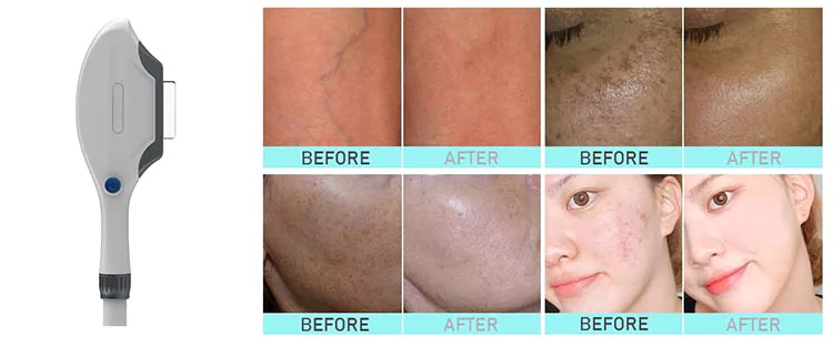 IPL Device: The Ultimate Beauty Treatment Machine 2 IPL before after