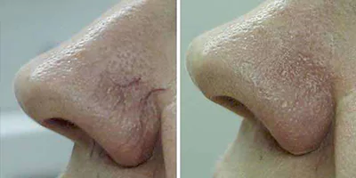 980 nm Diode Laser Vascular Removal Machine for Sale 20 IPL vascular therapy (2)