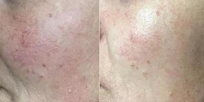 980 nm Diode Laser Vascular Removal Machine for Sale 22 Vascular treatment