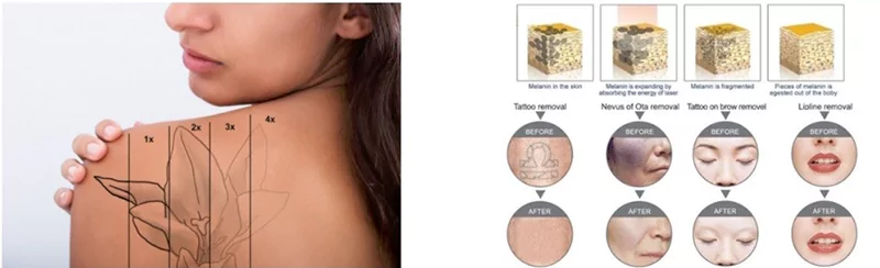 980 nm Diode Laser Vascular Removal Machine for Sale 31 ND YAG LASER working theory 3