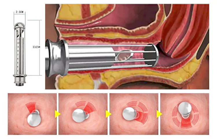 Medspa Classic Treatment - Carbon Dioxide Fractional Laser 3 co2 laser vaginal tightening theory