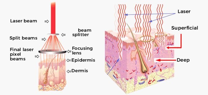 Skin Rejuvenation Treatment 21 co2 laser working theory e1690867827983