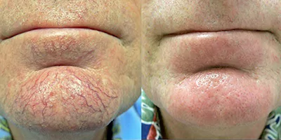 980 nm Diode Laser Vascular Removal Machine for Sale 18 diode laser 980nm spider vein removal (2)