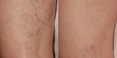 980 nm Diode Laser Vascular Removal Machine for Sale 19 Vascular treatment for leg