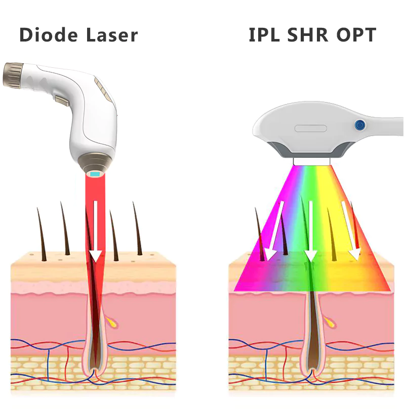 Blog 74 diode laser dh vs ipl SHR OPT