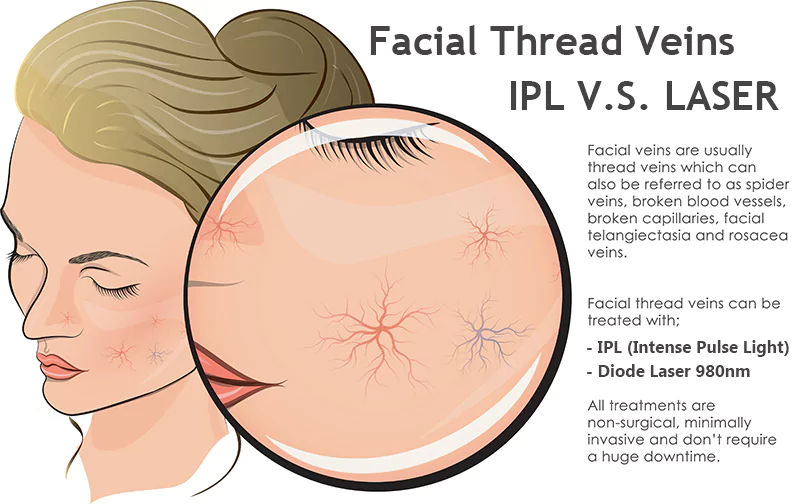 980 nm Diode Laser Vascular Removal Machine for Sale 30 facial veins