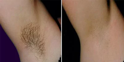 808nm Laser Diode Hair Removal Equipment 38 laser hair removal by beauty device (10)