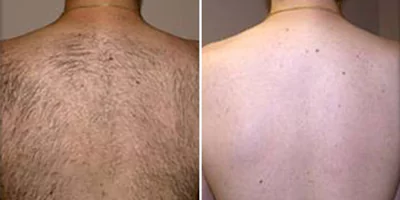 High Quality Diode Laser Hair Removal Device 22 Full back depilation