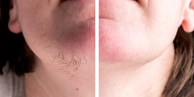 808 Diode Laser Hair Removal Machine 25 Beard hair removal