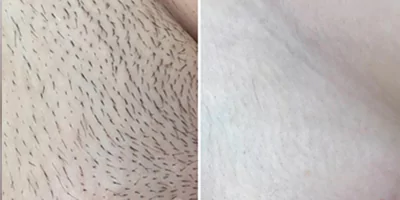 IPL SHR OPT Hair Removal Salon Machine 27 Bikini hair removal