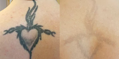 Professional Tattoo Removal Machine ND Yag Laser 18 Dark color tattoo removal