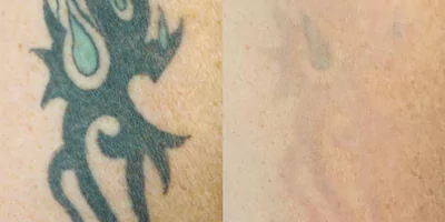 Diode Laser + ND Yag Laser Hair Removal Machine 2 in 1 System 14 Tattoo removal