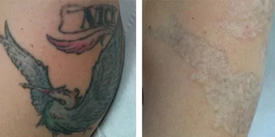 4 in 1 Laser Multifunctional Beauty Machine Diode ND Yag Elos RF 28 Tattoo removal effect