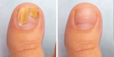 980 nm Diode Laser Vascular Removal Machine for Sale 21 nail fugus removal effect