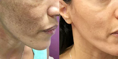 IPL SHR OPT Hair Removal Salon Machine 31 Pigmentation treatment