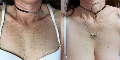 4 in 1 Laser Multifunctional Beauty Machine Diode ND Yag Elos RF 32 Pigmentation treatment