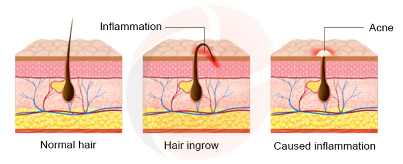 The First Choice for Laser Hair Removal 2 razor wax may cause skin inflamation