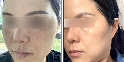 IPL SHR OPT Hair Removal Salon Machine 30 Photorejuvenation effect