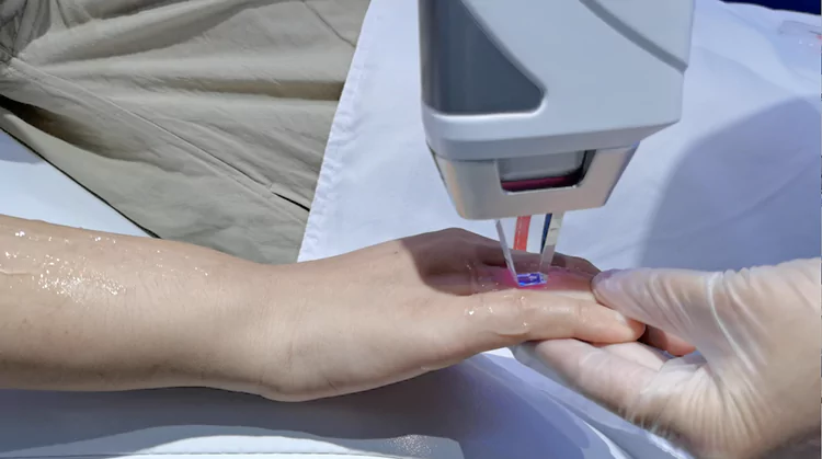 808 Diode Laser Hair Removal Machine 21 small tip for large area hair removal