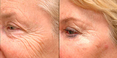 4 in 1 Laser Multifunctional Beauty Machine Diode ND Yag Elos RF 35 Wrinkle removal effect